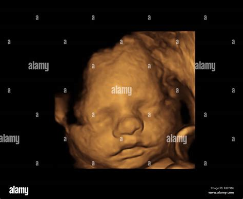 Foetus' face, Coloured 3-D ultrasound scan of a foetus, Gestational age : 31 weeks and 4 days ...