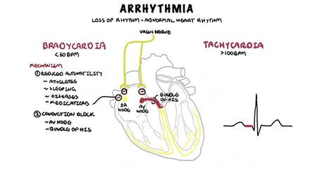 What Are The Signs And Symptoms Of An Arrhythmia?