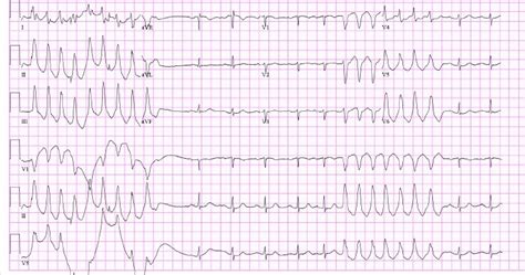 Pulseless Ventricular Tachycardia