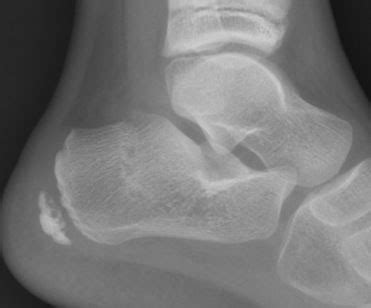 Clinical Practice Guidelines : Calcaneus Fractures - Emergency Department