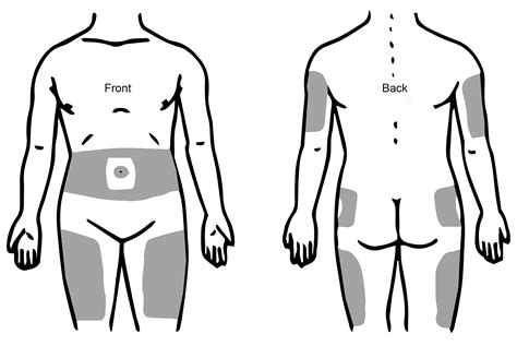 Injecting insulin | University of Iowa Health Care