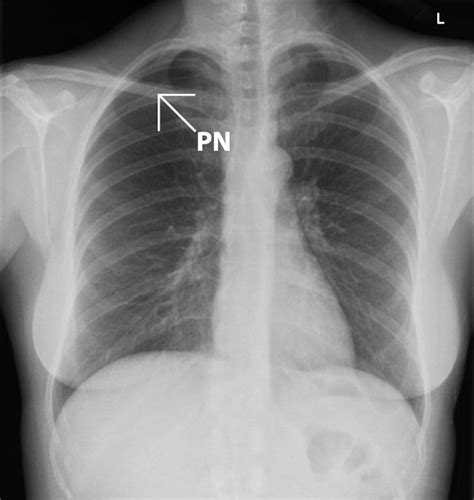 Cureus | Pneumothorax Following Acupuncture