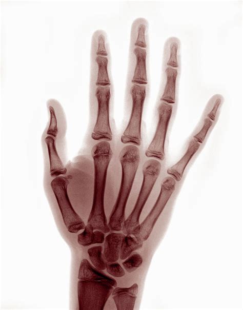 X-ray Of Hand Showing Reduced Thumb Dislocation Digital Art by Callista Images | Fine Art America