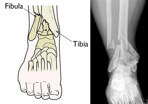 Illustration and x-ray of a pilon fracture | Fractures, Ankle joint, Ankle