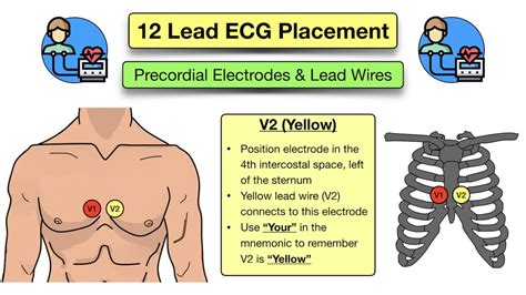 12 Lead ECG Placement: Diagram and Mnemonic for Limb and Precordial ...