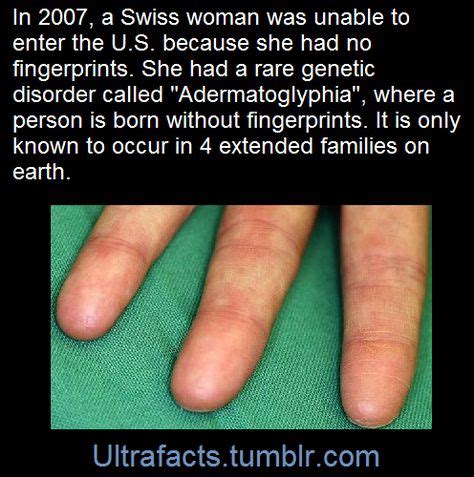 ultrafacts: “ Adermatoglyphia is an extremely rare genetic disorder which causes a person to ...