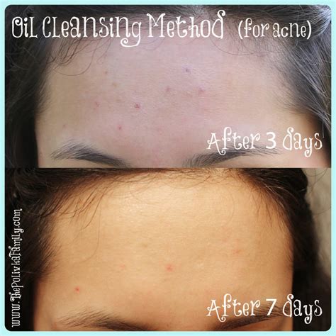 Using the Oil Cleansing Method To Reduce Acne