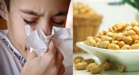 peanut allergy - FDA approves new drug | TheHealthSite.com