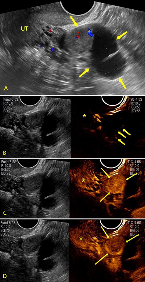 Fallopian Tube Cyst Ultrasound