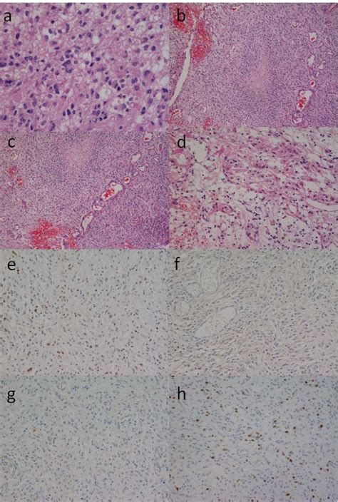 Photomicrographs showing histological findings of the tumor tissue in ...