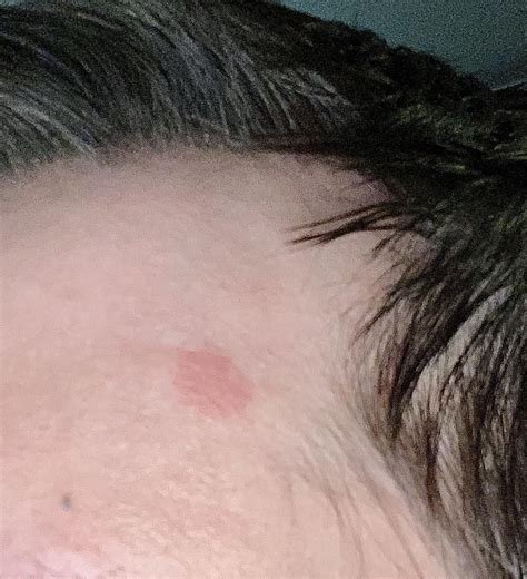 Red spot on Forehead : r/DermatologyQuestions