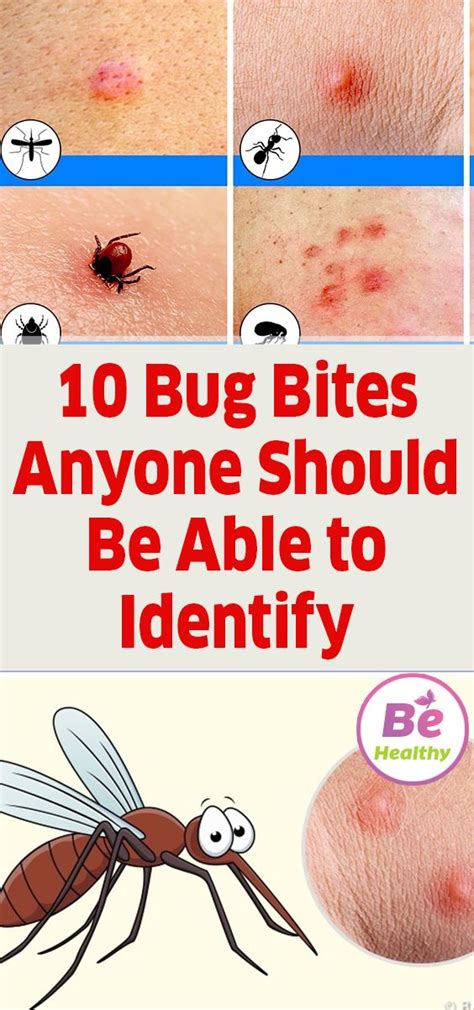 10 Bug Bites Anyone Should Be Able to Identify | Bug bites, Identifying insect bites ...