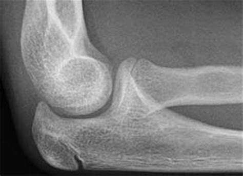 Osteochondritis Dissecans of Elbow - Sports - Orthobullets.com