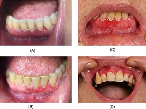 Clinical presentation of desquamative gingivitis in three selected patients | Download ...