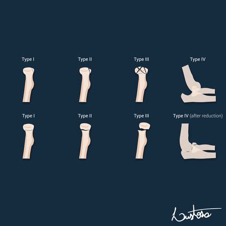 Mason Classification Radial Head