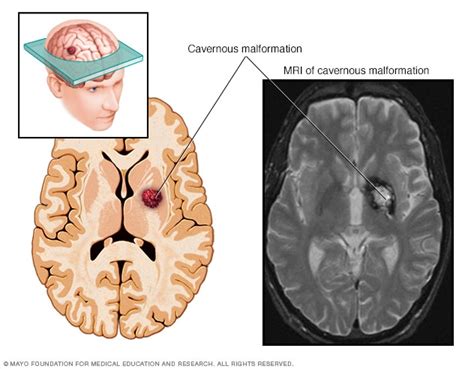 Cavernous malformations - Symptoms and causes - Mayo Clinic