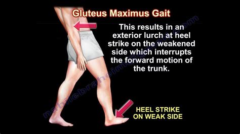 Gluteus Maximus Gait - Everything You Need To Know - Dr. Nabil Ebraheim ...