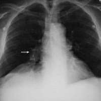 Pulmonary Embolism Chest X Ray