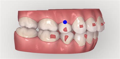 When Do Invisalign Attachments Come Off? - 1311 Jackson Ave Dental | Dentist in Long Island City, NY