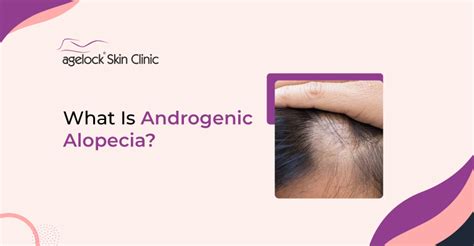 What Is Androgenic Alopecia? Causes, Treatment & Side Effects - Agelock ...