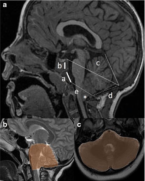 Main bi-dimensional PCF measurements on MRI (A): clivus basiocciput... | Download Scientific Diagram