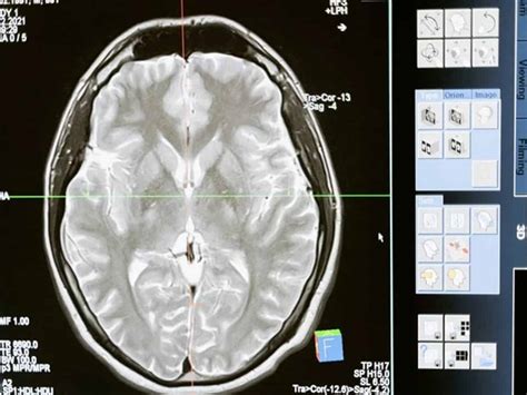 8-cm live worm removed from woman's brain in world's 1st discovery