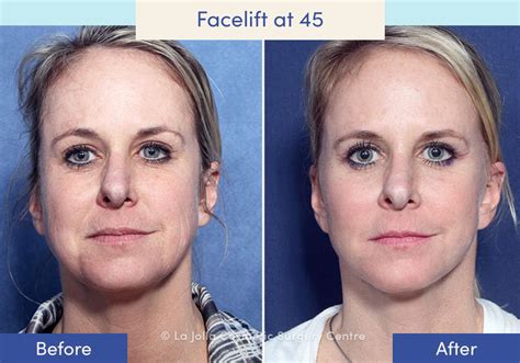 Facelift Before & After Photos: What a Facelift Looks Like at 40, 50 ...