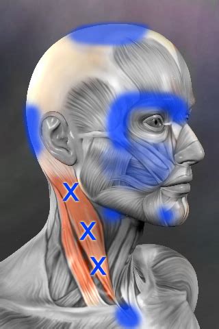 Sternocleidomastoid trigger points - Real Bodywork