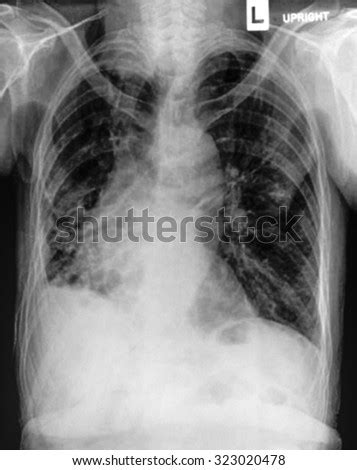 Pneumatocele Stock Photos, Royalty-Free Images & Vectors - Shutterstock