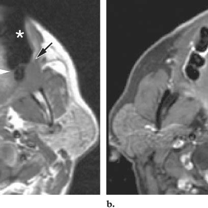 Normal hypopharynx. (a) Axial CT scan obtained during quiet respiration... | Download Scientific ...