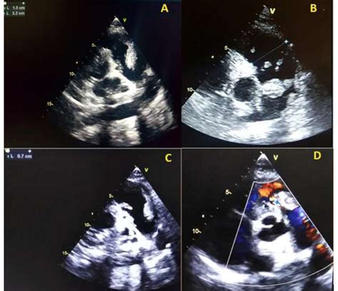 transthoracic echocardiography showing (A) large highly mobile pulmonic... | Download Scientific ...