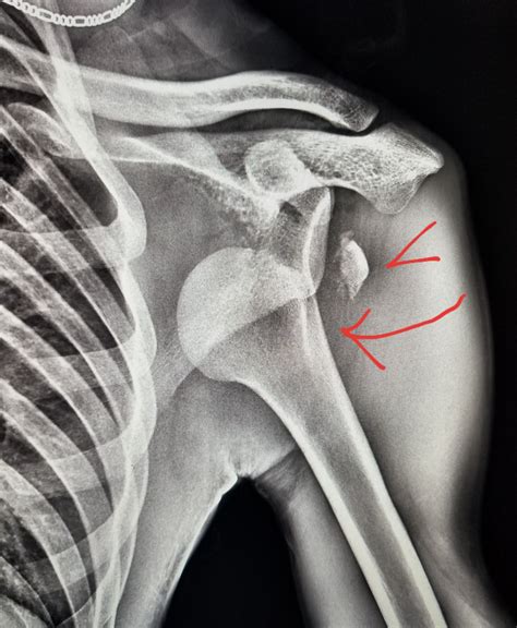 Pin on X-rays