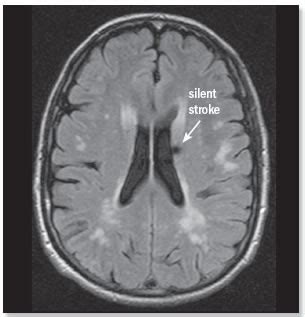 Stroke Brain Mri