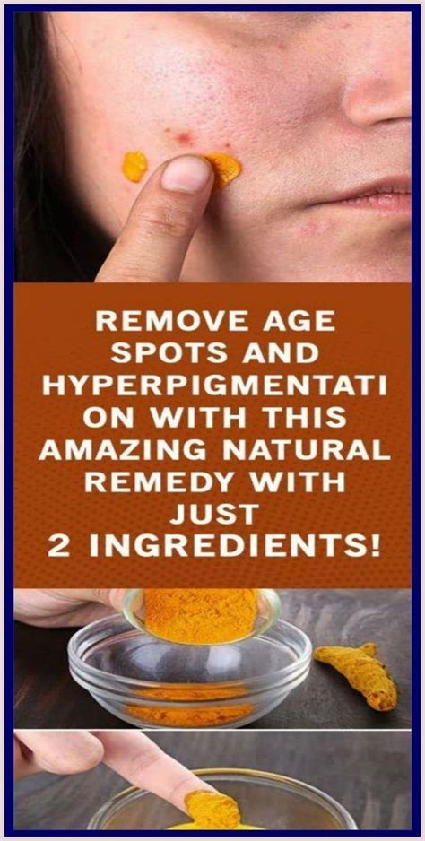 Remove Age Spots And Hyperpigmentation With This Amazing Natural Remedy ...