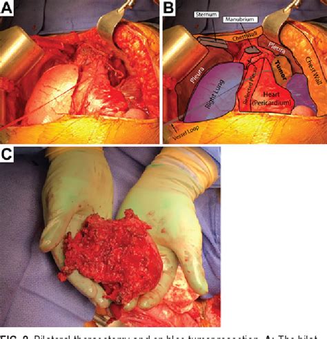 Figure 3 from Clamshell thoracotomy for en bloc resection of a 3-level ...