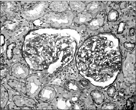 The mesangium is mildly expanded with proliferations of mesangial cells ...