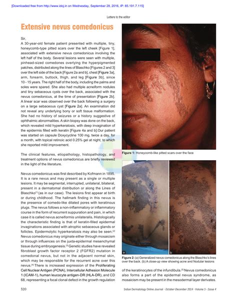 (PDF) Extensive nevus comedonicus