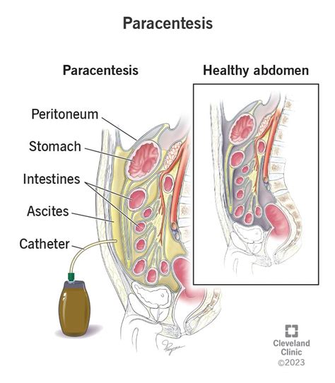 Paracentesis: What It Is, Procedure & Complications