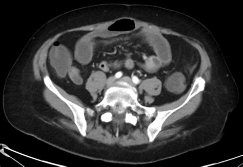 Clinical case: Abdominal pain in a patient with a previous history of abdominal surgery - MDCT.net