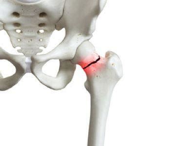 Osteoporosis and Fractures: New Braunfels Orthopaedic Surgery & Sports ...