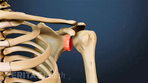 What is Shoulder Osteoarthritis (Glenohumeral Arthritis)? | Arthritis-Health