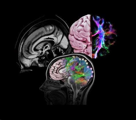 Healthy brain, composite of tractography, MRI and artwork | Wellcome Collection