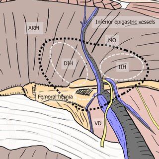 Complete preservation of the vas deferens and gonadal vessels. A ...