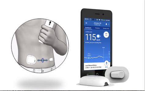 New Omnipod® Closed Loop Insulin Delivery System Improves Glycemic Control | Free Hot Nude Porn ...