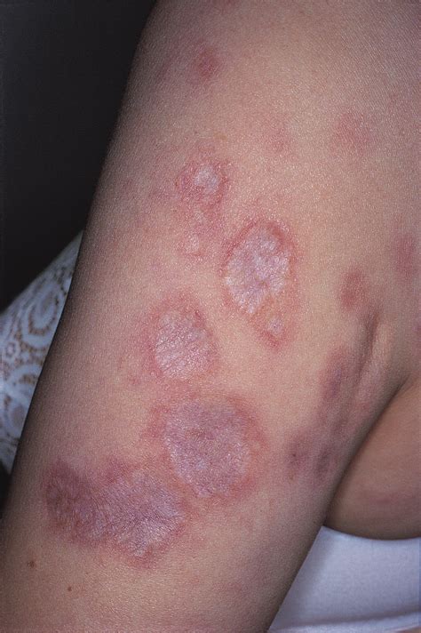 Cutaneous Sarcoidosis Successfully Treated With Low Doses of Thalidomide | Dermatology | JAMA ...