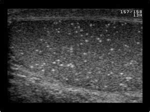 Urinary Tract and male reproductive system | 2.3 Scrotum : Case 2.3.13 Microlithiasis and ...