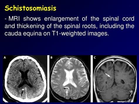 Eosinophilic meningitis