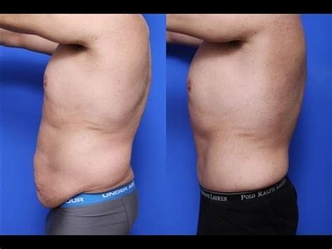 Male Mini Tummy Tuck Before And After Kirkland WA - Dr. Brian Windle - YouTube