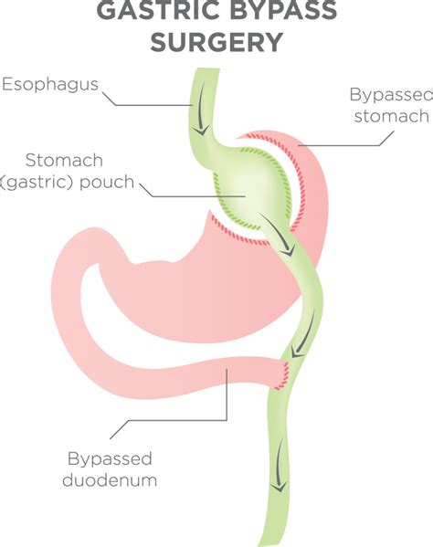 Gastric Bypass Surgery Near Johnstown and Windber, PA - Chan Soon-Shiong Medical Center at Windber