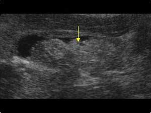 Abdomen and retroperitoneum | 1.2 Gallbladder and bile ducts : Case 1.2 ...